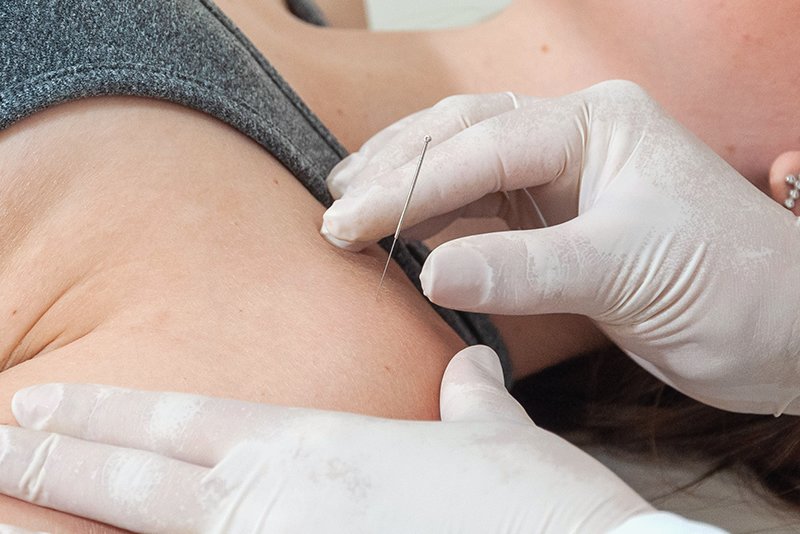Dry Needling
