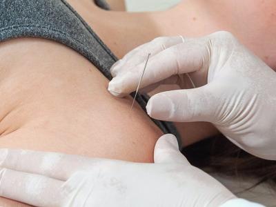 Dry Needling